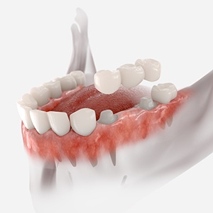 Dental bridge illustration