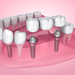 Dental implant bridge illustration